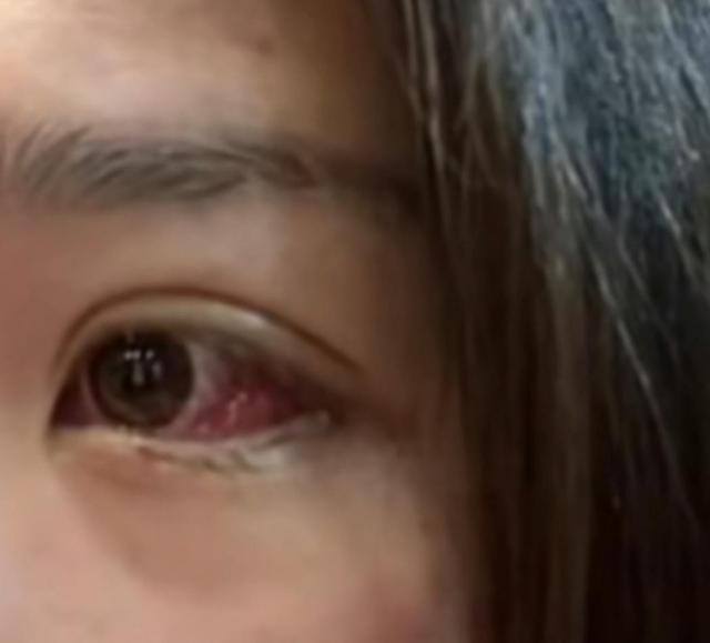 上海女足熊鑫身患肿瘤，3小时筹到50万，化疗前眼睛已有血块